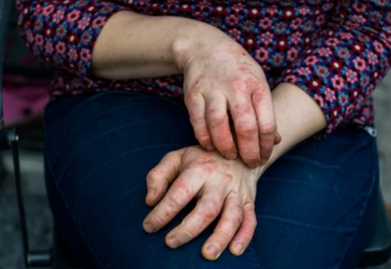 Bad eczema flare-ups may be caused by strains of bacteria